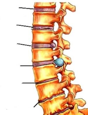 Osteocondritis da columna vertebral