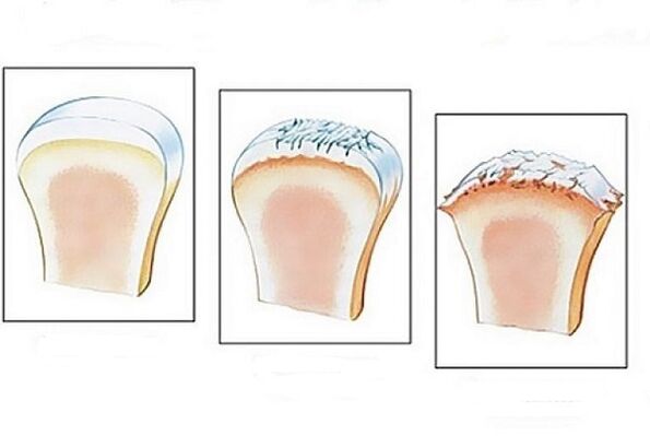 Danos nas articulacións en varias etapas do desenvolvemento da artrose