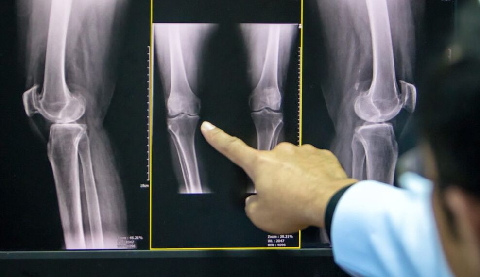 radiografía de artrose do xeonllo