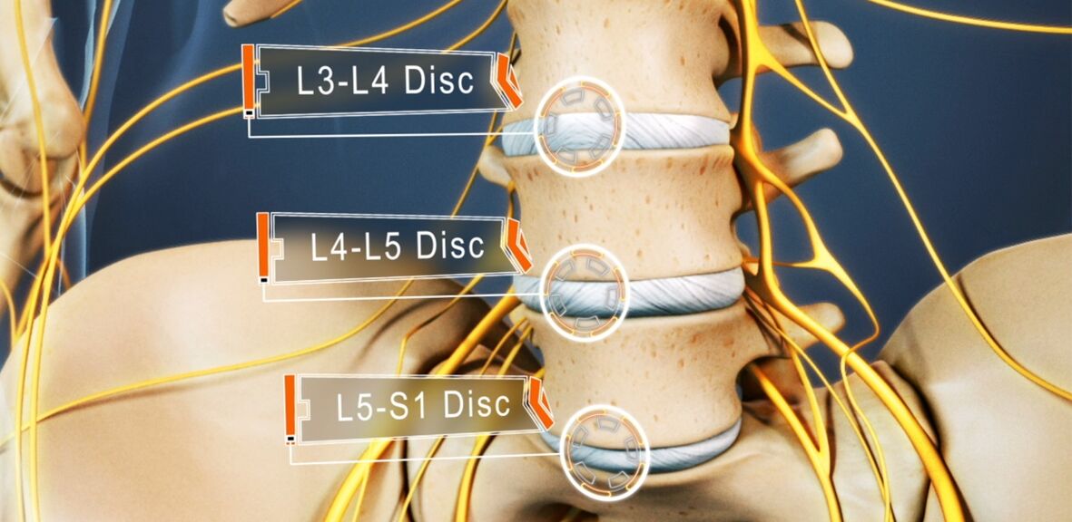 Discos intervertebrais da columna lumbar, que son máis frecuentemente afectados na osteocondrose
