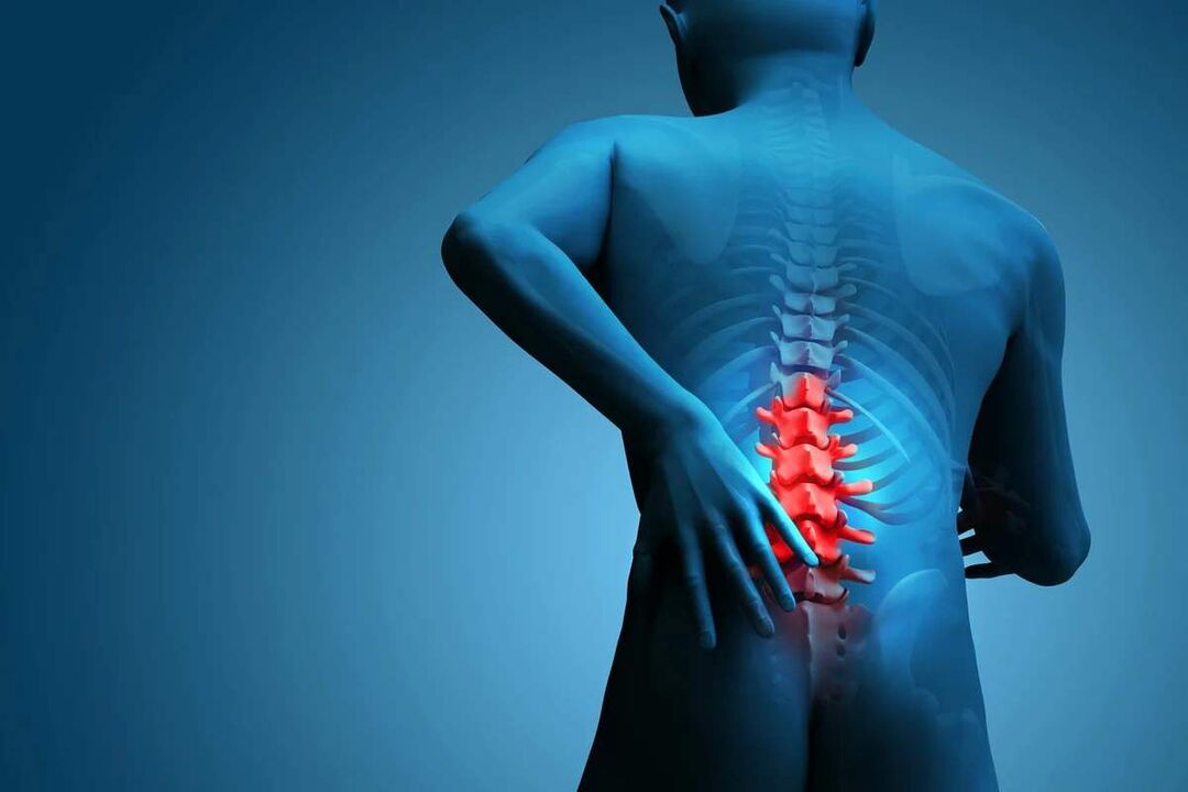 O principal síntoma da osteocondrose da columna lumbar é a dor nas costas. 