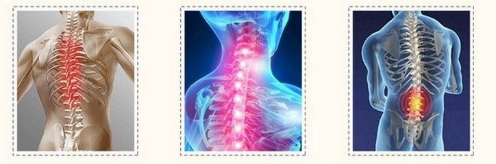 Osteocondrose de diferente columna vertebral