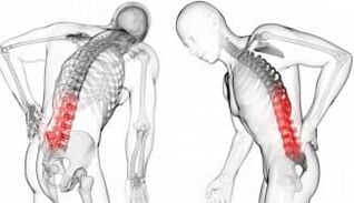 Hernia vertebral intermedia - complicación con osteocondrose