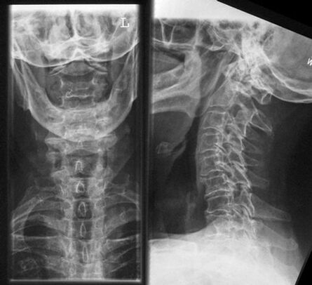 Diagnóstico de xacemento cervical X -Ray do método de osteocondrose