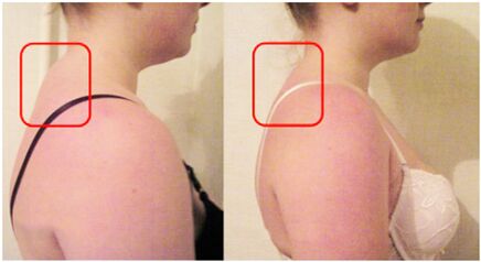 Formación de rolos musculares con osteocondrose cervical