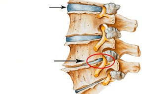 Columna vertebral normal e danada con osteocondrose cervical
