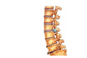 Danos na columna vertebral con osteocondrose cervical