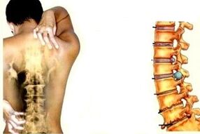 Dor de costas en diferentes etapas do desenvolvemento da osteocondrose cervical