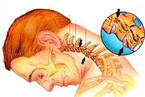 nervio pinchado na columna vertebral con osteocondrose cervical