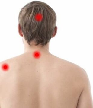 Localización da dor na osteocondrose cervical