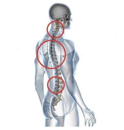 Sitios de osteocondrose espinal