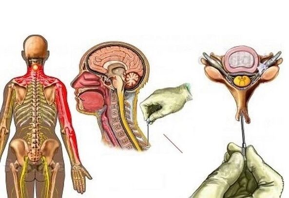 Tratamento da osteocondrose cervical con acupuntura