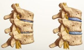 Como é a osteocondrose